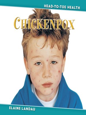 Chickenpox - ebook